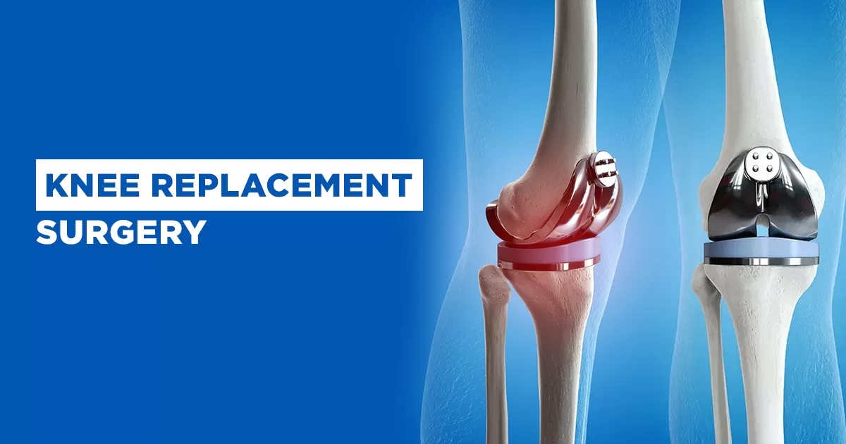 Knee Replacement Surgery in Ghaziabad